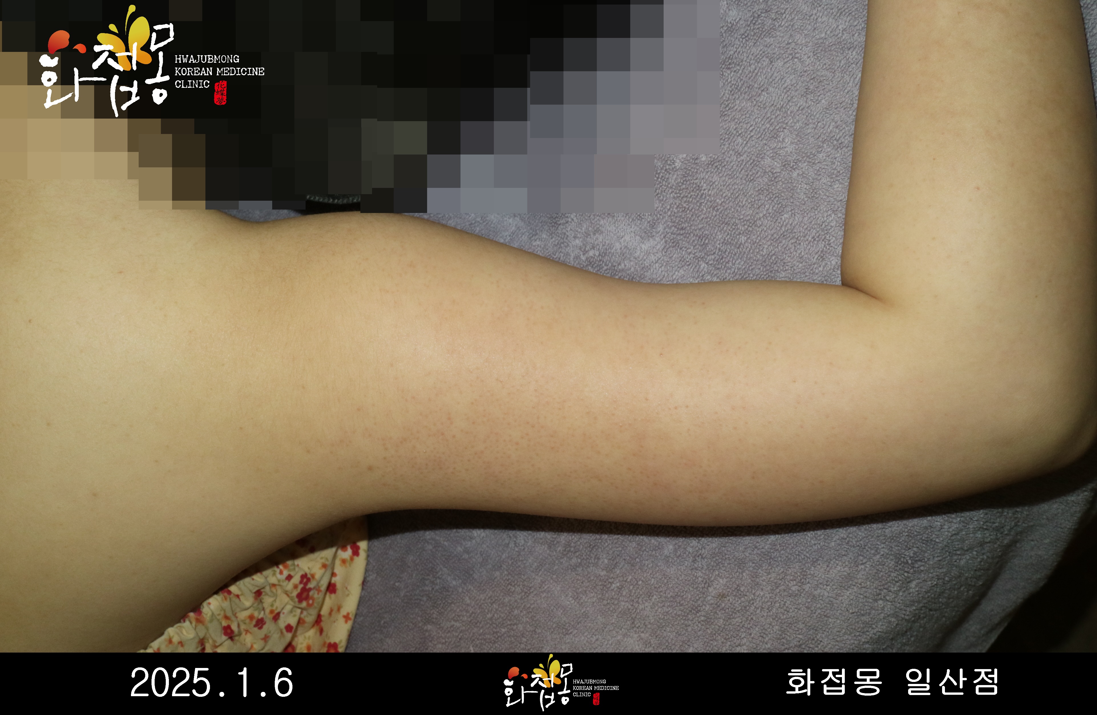 전후사진