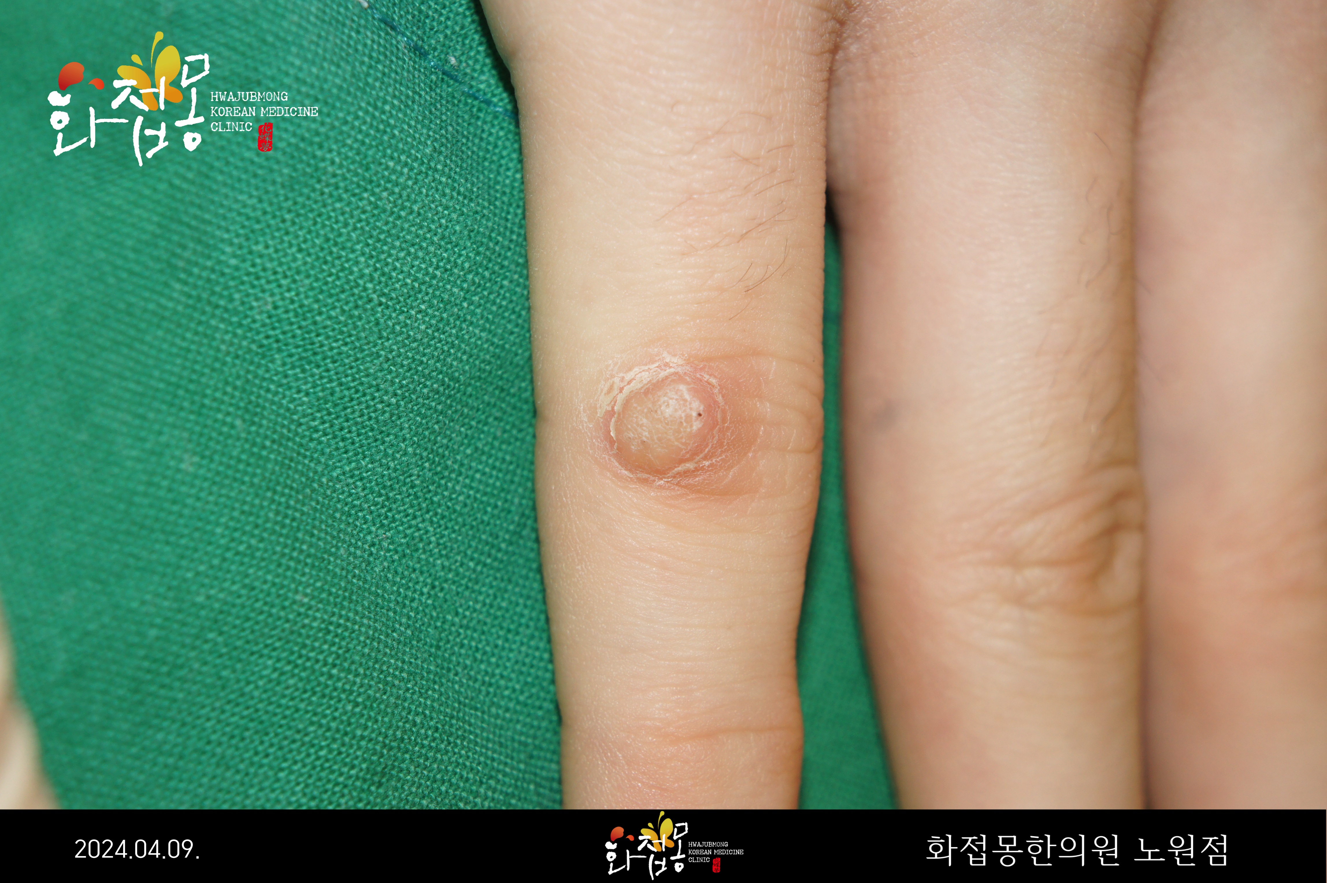 전후사진