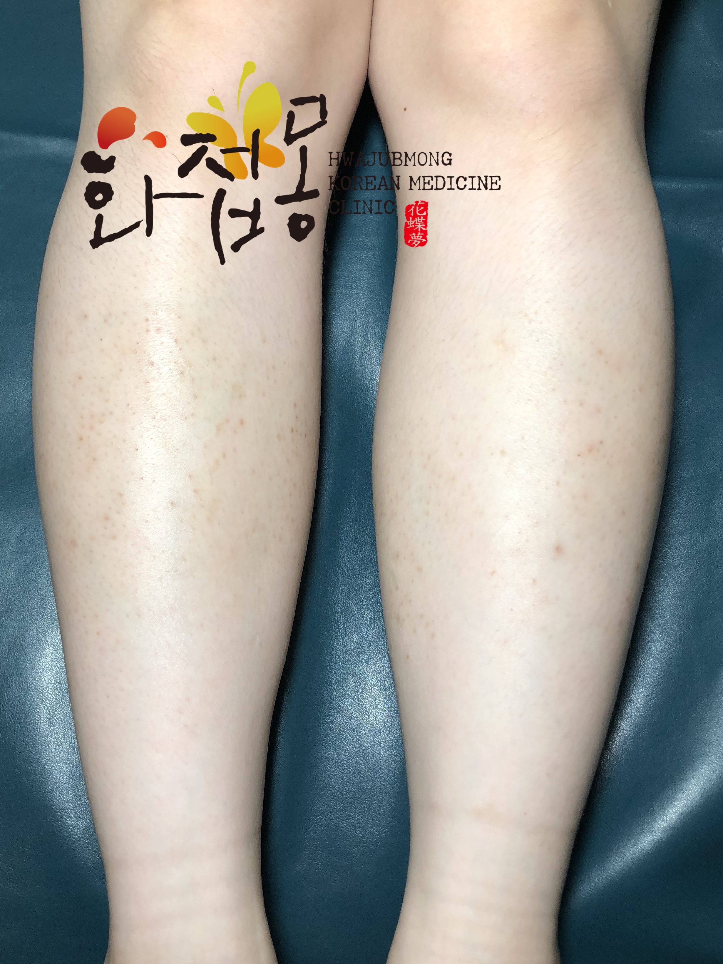 전후사진