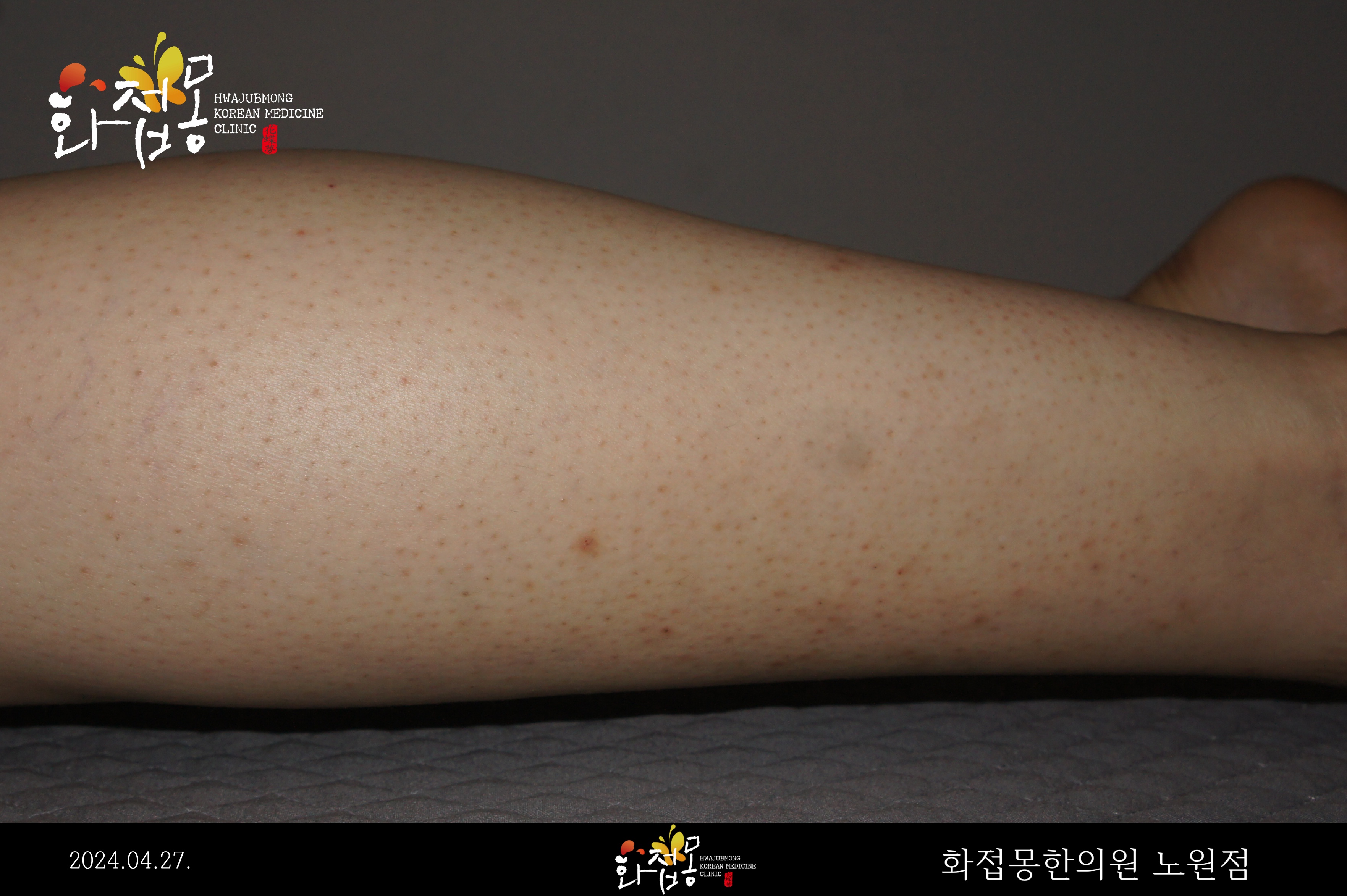 전후사진