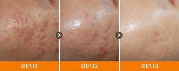 화접몽한의원 편평사마귀 전후사진