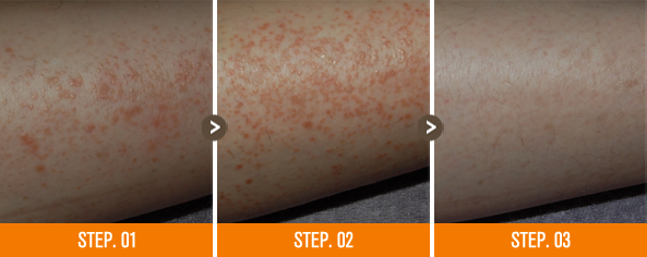 화접몽한의원 편평사마귀 전후사진