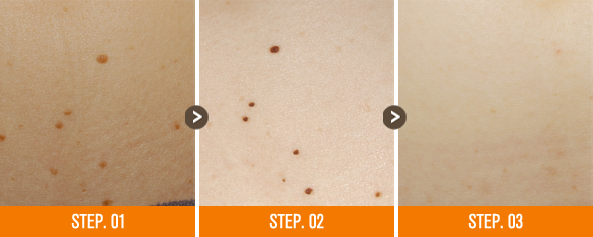 화접몽한의원 편평사마귀 전후사진