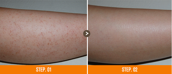 화접몽한의원 모공각화증 전후사진