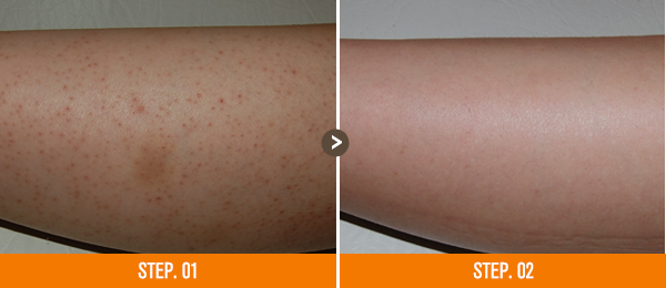 화접몽한의원 모공각화증 전후사진