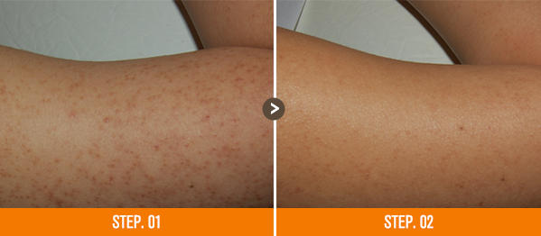 화접몽한의원 모공각화증 전후사진