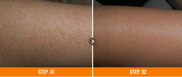 화접몽한의원 모공각화증 전후사진